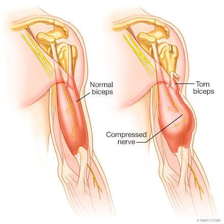 generelt tunnel dække over Biceps tendonitis - Overview - Mayo Clinic Orthopedics & Sports Medicine