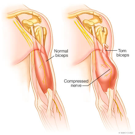 torn muscle in shoulder